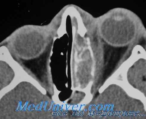 эндокринная офтальмопатия