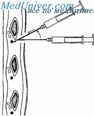межреберная блокада