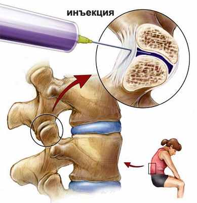 Паравертебральное введение лекарственных препаратов, блокада межреберных промежутков