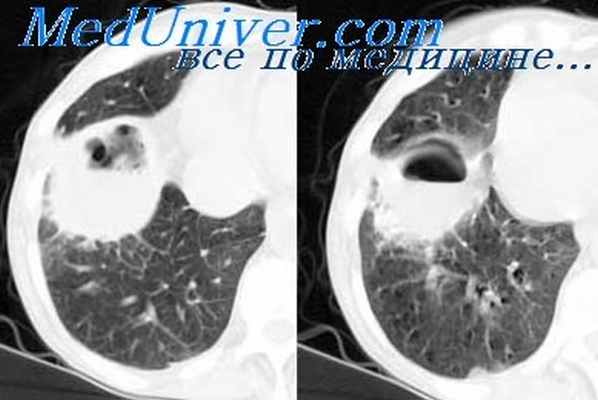 эмпиема плевры