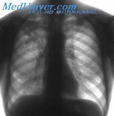 туберкулез на снимке