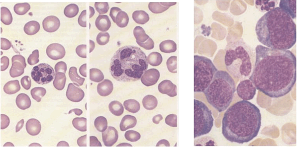 Рассмотрена взаимосвязь железодефицитной анемии с потерей слуха
