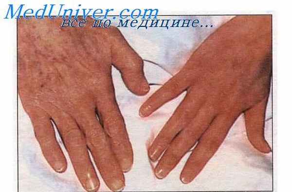 признаки анемии