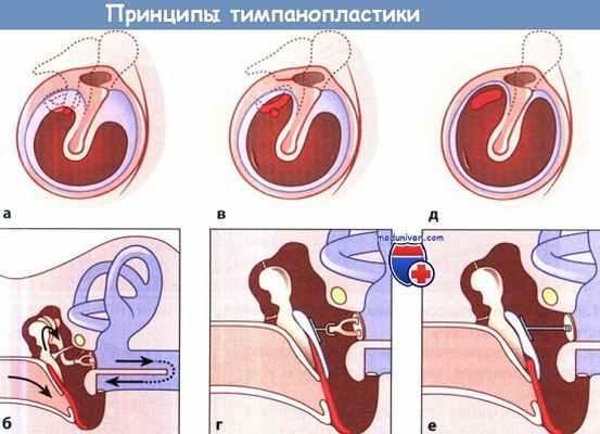 Принципы тимпанопластики
