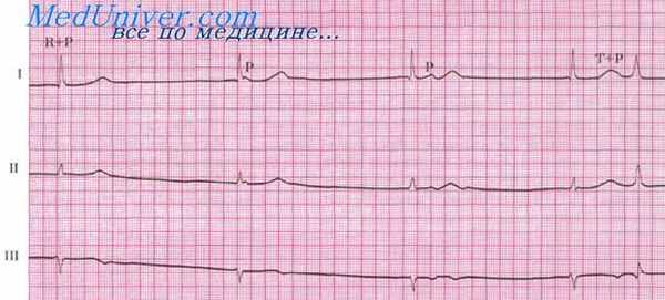 атриовентрикулярная диссоциация