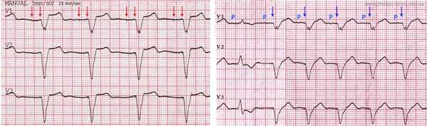 2 chamber pacing expl