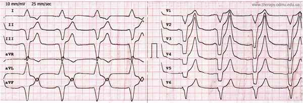 single chamber pacing bipolar filtered