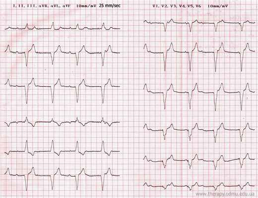 single chamber pacing bipolar