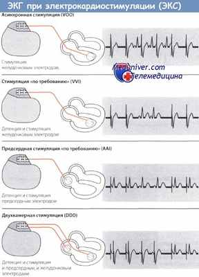 ЭКГ при электрокардиостимуляции