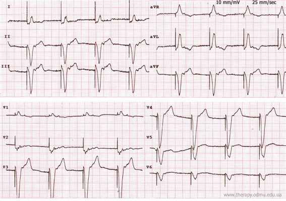 single chamber pacing unipolar
