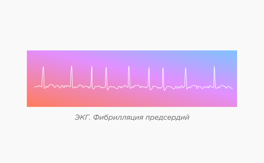 Сравнение синусового ритма