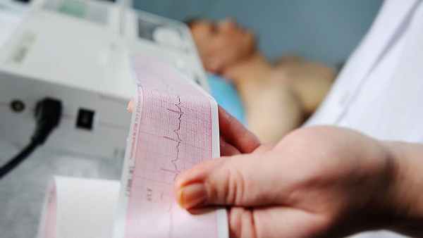 Фибрилляция предсердий