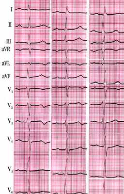 Стенокардия