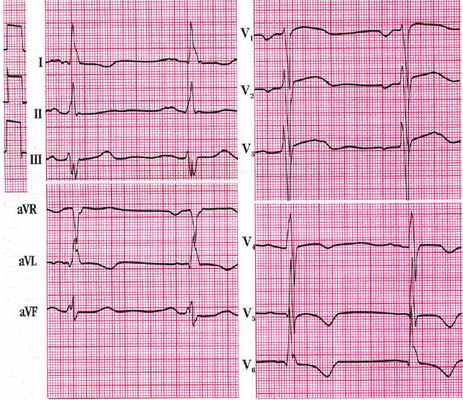 Гипертрофия