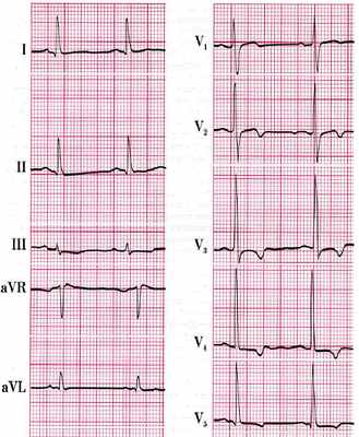 Миокардиодистрофия