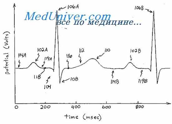 экг при миокардитах