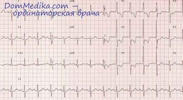 гипертрофия желудочков сердца