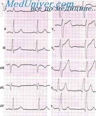 гипертрофия левого желудочка