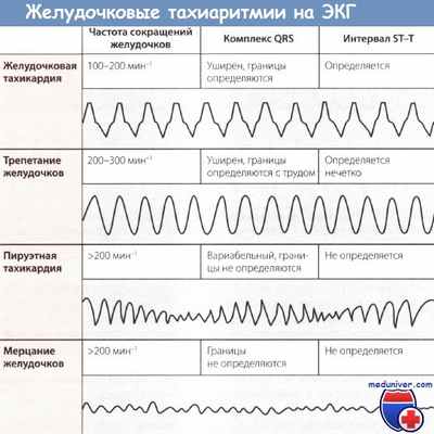 Желудочковые тахиаритмии на ЭКГ