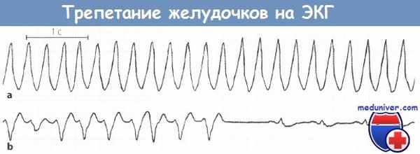 Трепетание желудочков на ЭКГ