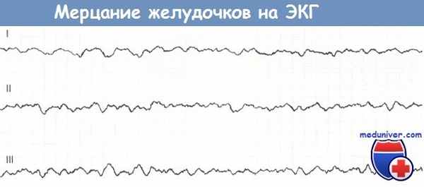 Мерцание желудочков на ЭКГ