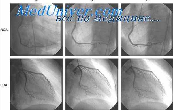 нестабильная стенокардия