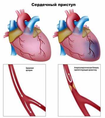 Атеросклеротическая бляшка.jpg