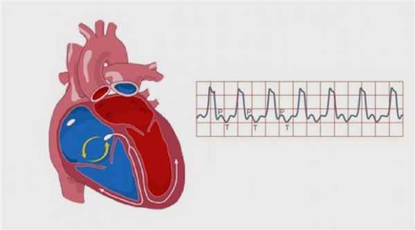 Желудочковая тахикардия