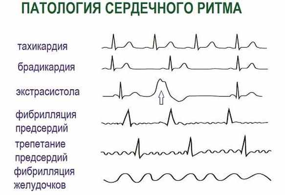 Варианты аритмии сердца на ЭКГ