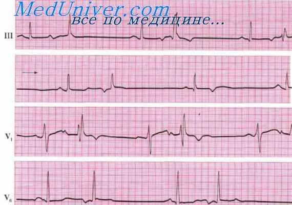 экг при парасистолиях