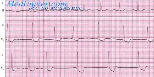 передозировка гликозидов