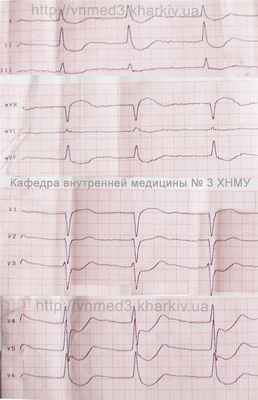 ecg2glic