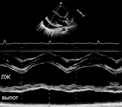 Выпот в перикард по эхокардиографии