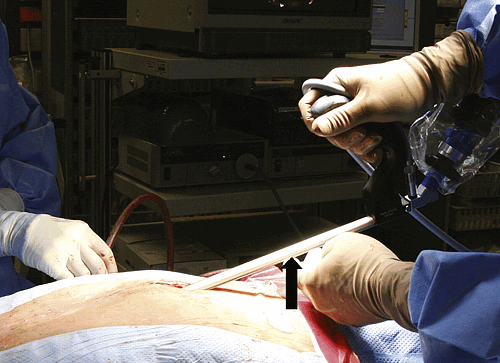 Перикардиоскопия с биопсией