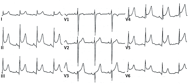 ЭКГ при остром перикардите