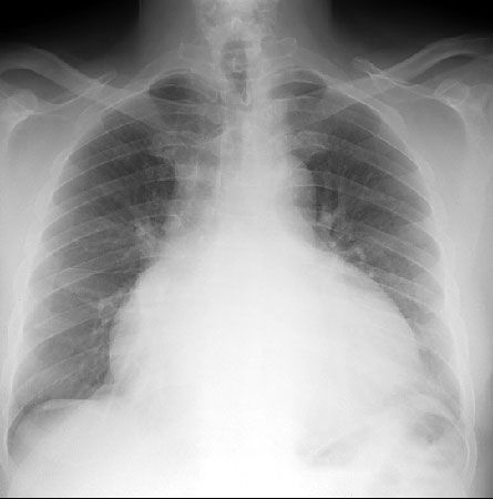 выпотной перикардит