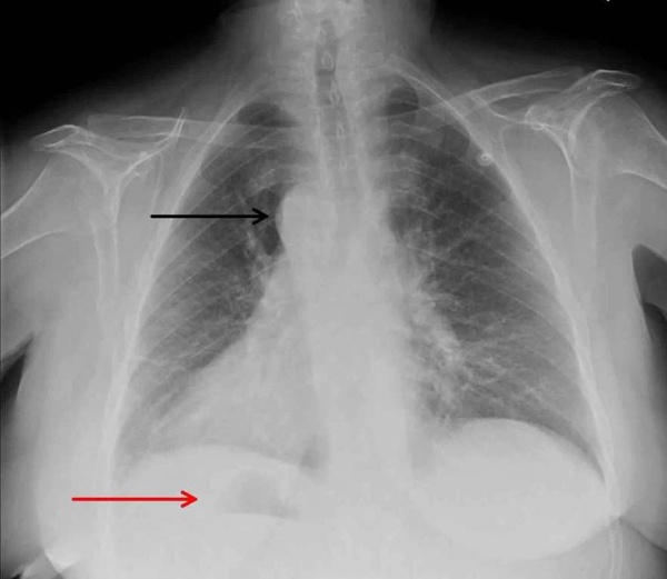 Рентгенография ОГП. Декстрокардия: дуга аорты (черная стрелка), правый желудочек (красная стрелка).