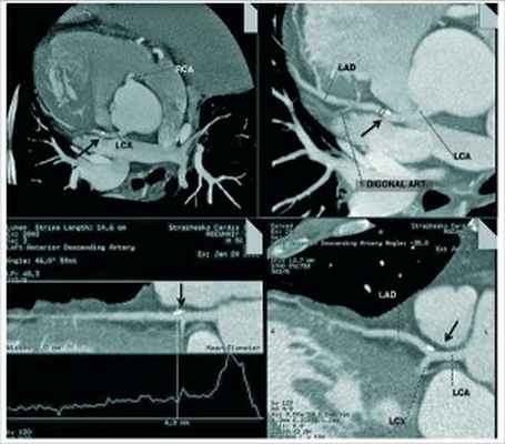 Рис. 7. КТ2изображения ПМЖВ ЛКА (МСКТ2 постпроцессинговая обработка). КТ2признаки локального кальциноза в проксимальном сегменте ПМЖВ ЛКА, без гемодинамически значимого стеноза на указанном уровне (стрелка)