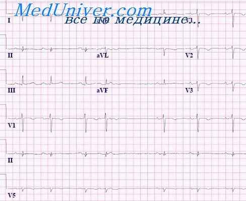 праворасположенное сердце