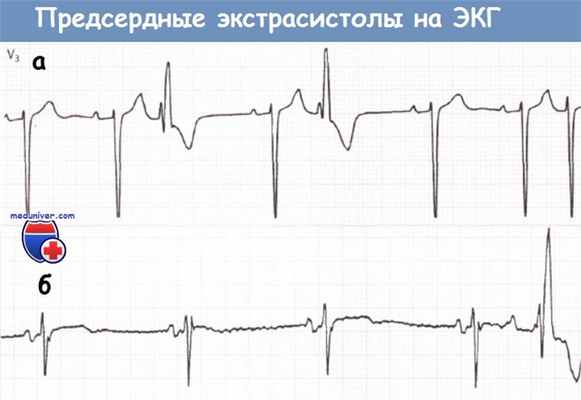 Предсердные экстрасистолы на ЭКГ