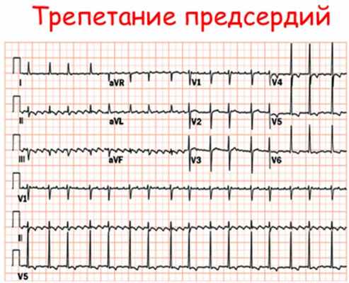 Трепетание предсердий