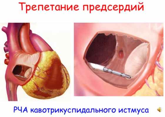 Трепетание предсердий