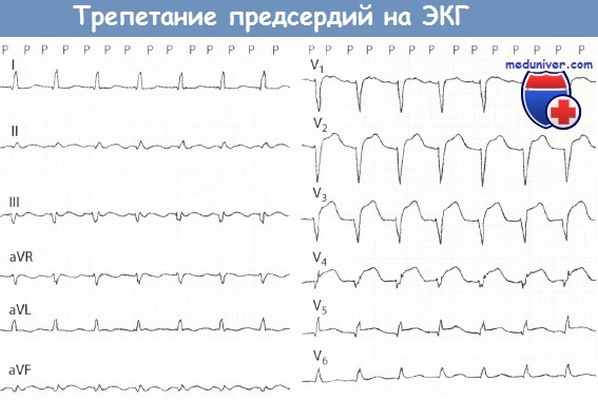 Трепетание предсердий на ЭКГ