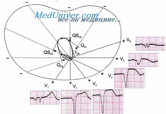 ekg3
