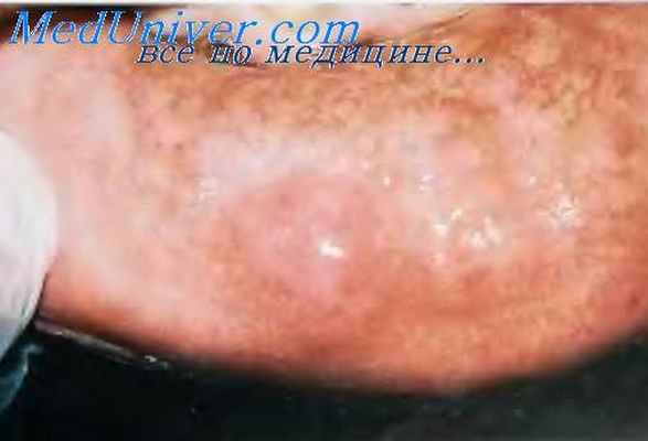 Имплантационная киста.