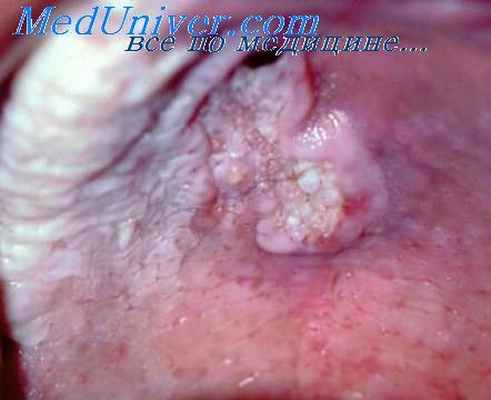 гастрит кровь слюне