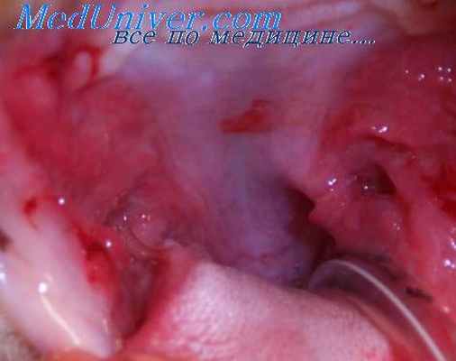 кровь при стоматите