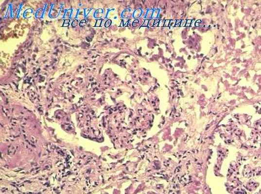 ларвальный парагонимоз