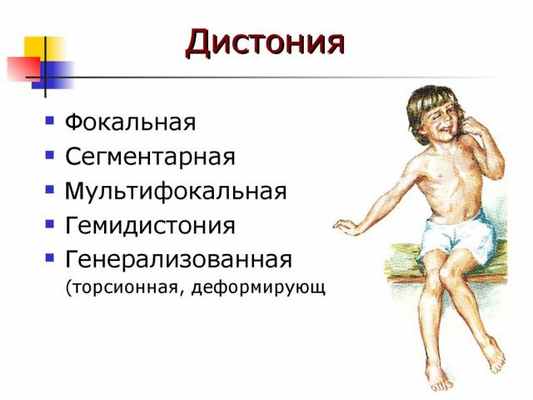 дистония