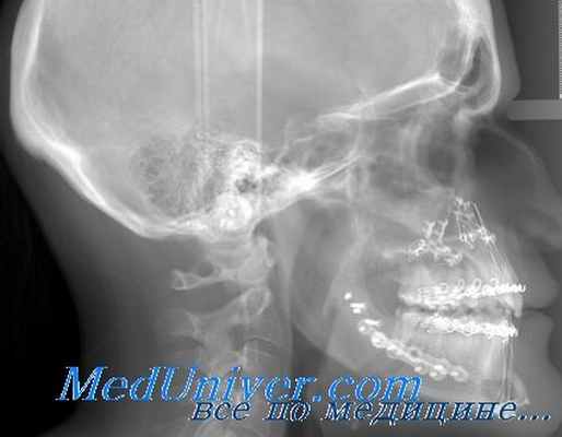 супраселлярные опухоли гипофиза
